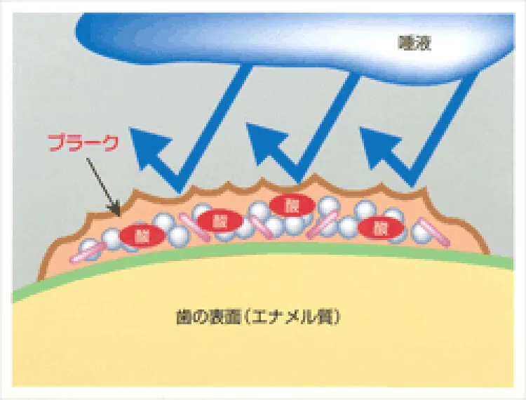 歯の表面のプラーク