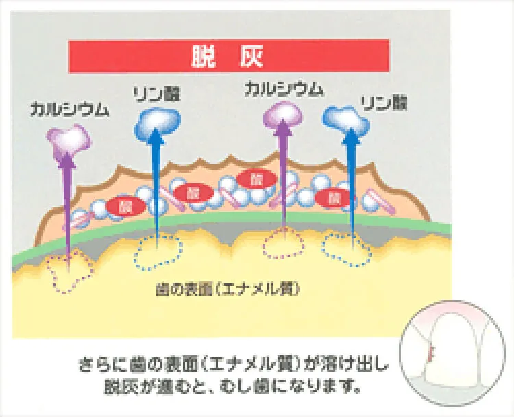 歯の表面（エナメル）が溶け出し脱灰が進むと、むし歯になります。