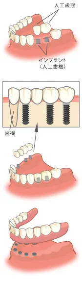 インプラント治療とは