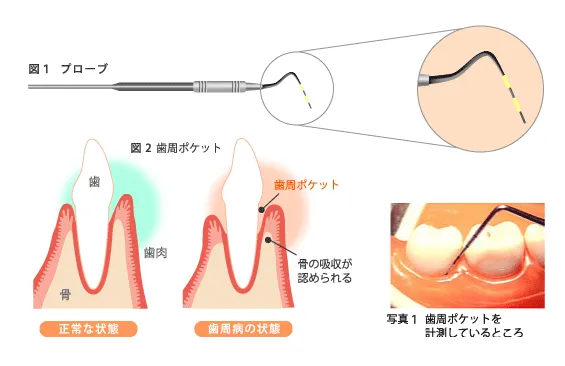 歯周ポケット検査